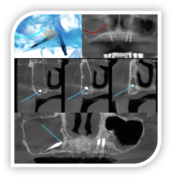 Collage from a DIDx radiology report: airway tracing on a volume render, panoramic reformat, and cross-sections with an incidental finding indicated by arrows